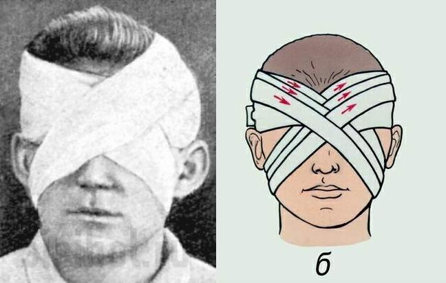 Повязки на голову шею. Десмургия бинокулярная повязка. Повязка на глаз десмургия. Бинокулярная повязка на оба глаза. Наложение бинокулярной повязки алгоритм.